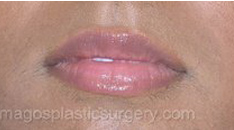 Before dermal fillers female patient case 4000