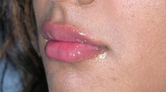 After dermal fillers left 3/4 female patient case 4000