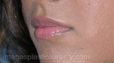 Before dermal fillers left 3/4 female patient case 4000