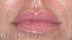 After dermal fillers female patient case 4005
