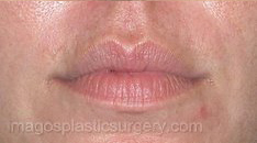 Before dermal fillers female patient case 4005