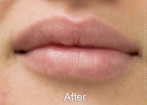 After dermal fillers female patient case 4009