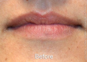 Before dermal fillers female patient case 4009