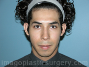 before front view ear surgery of male patient 2631
