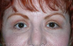 after front view eyelid surgery of female patient 3385