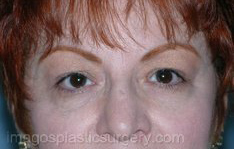 before front view eyelid surgery of female patient 3385