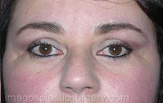 after front view eyelid surgery of female patient 3394