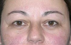 before front view eyelid surgery of female patient 3394