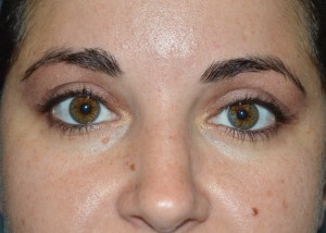 after front view eyelid surgery of female patient 3403