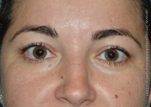 before front view eyelid surgery of female patient 3403