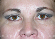 after front view eyelid surgery of female patient 3408