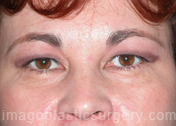 before front view eyelid surgery of female patient 3408