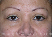 after front view eyelid surgery of female patient 3411