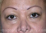 before front view eyelid surgery of female patient 3411