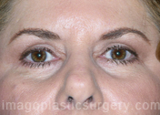 after front view eyelid surgery of female patient 3414