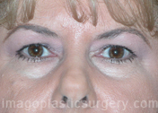before front view eyelid surgery of female patient 3414