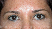 after front view eyelid surgery of female patient 3418