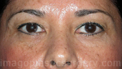 before front view eyelid surgery of female patient 3418