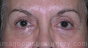 after front view eyelid surgery of female patient 3421
