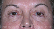 before front view eyelid surgery of female patient 3421