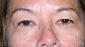 before front view eyelid surgery of female patient 3425