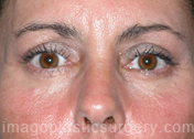 after front view eyelid surgery of female patient 3428