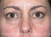 before front view eyelid surgery of female patient 3428