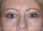 after front view eyelid surgery of female patient 3436