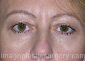 before front view eyelid surgery of female patient 3436