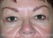 after front view eyelid surgery of female patient 3447
