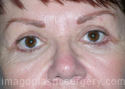 before front view eyelid surgery of female patient 3447
