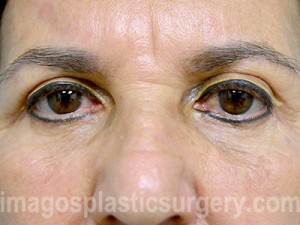 after front view eyelid surgery of female patient 3457