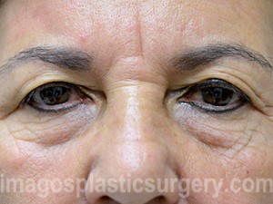 before front view eyelid surgery of female patient 3457