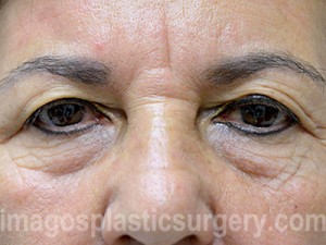 before front view eyelid surgery of female patient 3457