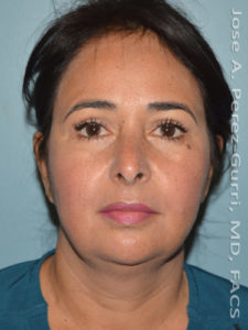 after front view eyelid surgery of female patient 3480