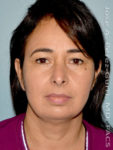 before front view eyelid surgery of female patient 3480
