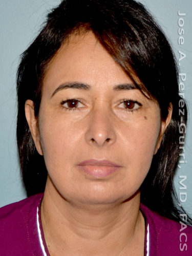 before front view eyelid surgery of female patient 3480