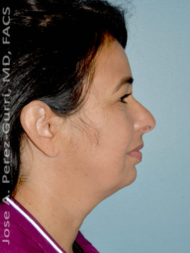 before right side view eyelid surgery of female patient 3480
