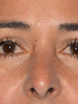 after closeup front view eyelid surgery of female patient 3480