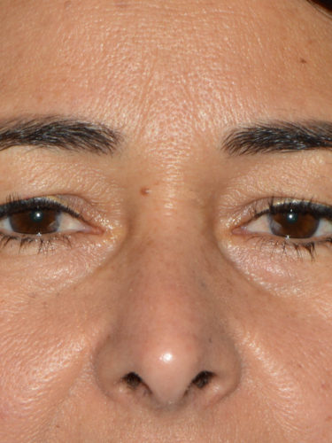 before front view eyelid surgery of female patient 3480