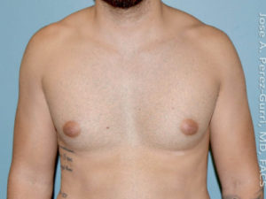 before front view gynecomastia of male patient 3267
