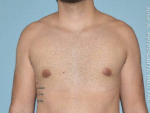 after front view gynecomastia of male patient 3267