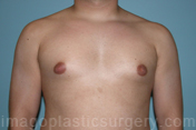 before front view gynecomastia of male patient 3276