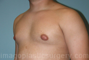before left angle view gynecomastia of male patient 3276