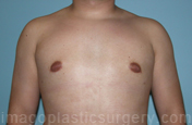 after front view gynecomastia of male patient 3276
