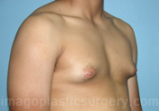 before right angle view gynecomastia of male patient 3281