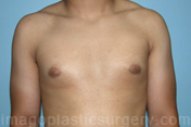 after front view gynecomastia of male patient 3281
