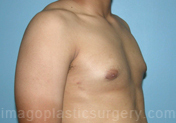 after right angle view gynecomastia of male patient 3281