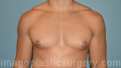 before front view gynecomastia of male patient 3286