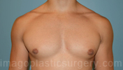 after front view gynecomastia of male patient 3286
